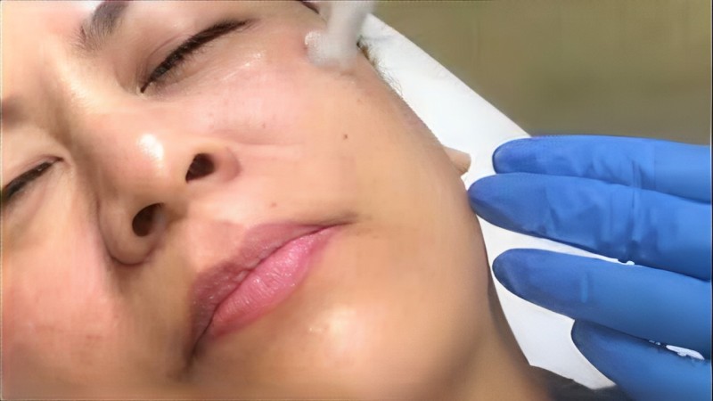 microneedlingwithdrsamra2 (1)