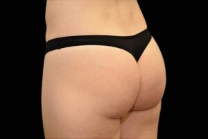 After Image: Buttocks