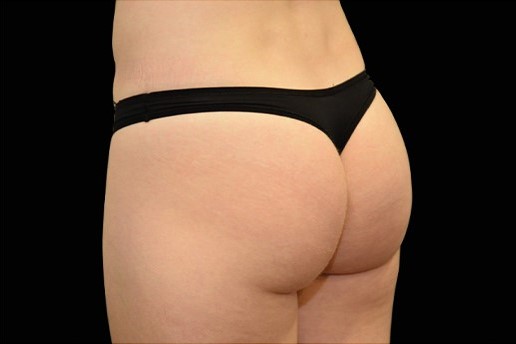 After Image: Buttocks - left-back-oblique