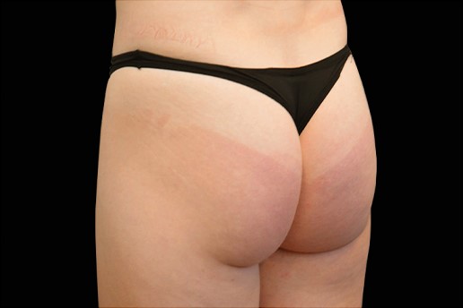 Before Image: Buttocks - left-back-oblique