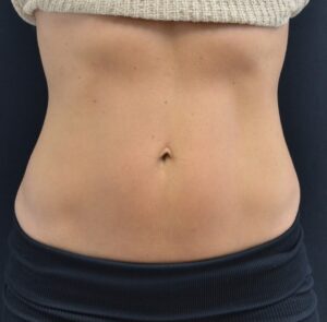 After Image: Abdomen