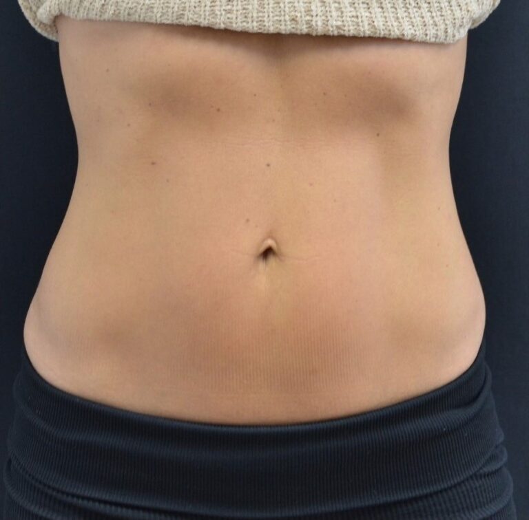 After Image: Abdomen - front