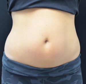 Before Image: Abdomen