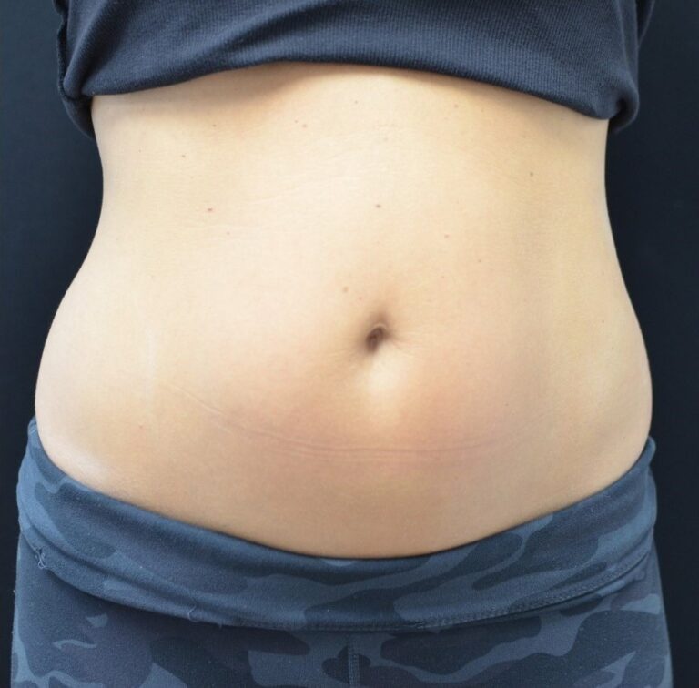 Before Image: Abdomen - front