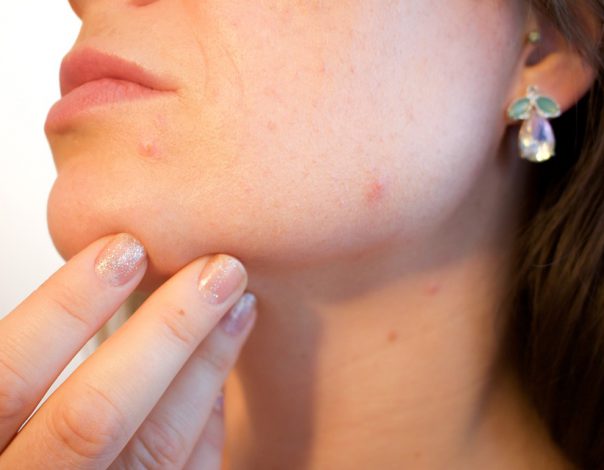 woman with acne