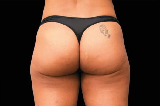 After Image: Buttocks - back
