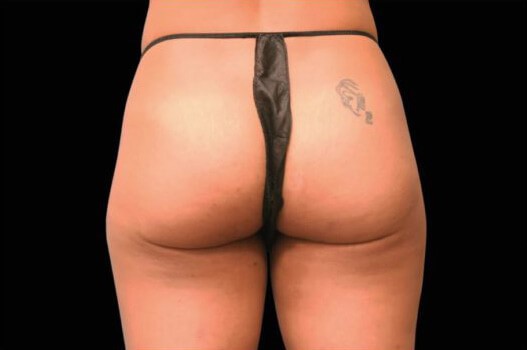Before Image: Buttocks - back