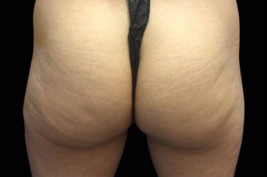 Before Image: Buttocks - back