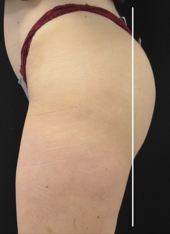 After Image: Buttocks - left-side