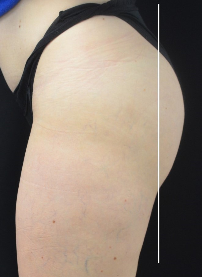 Before Image: Buttocks - left-side