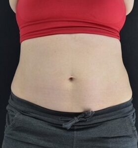 After Image: Abdomen