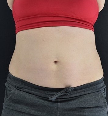 After Image: Abdomen - front