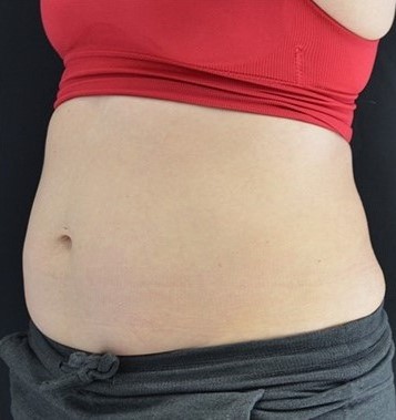 After Image: Abdomen - left-front-oblique