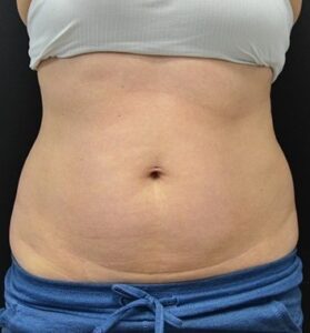 Before Image: Abdomen