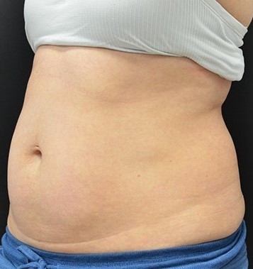 Before Image: Abdomen - left-front-oblique