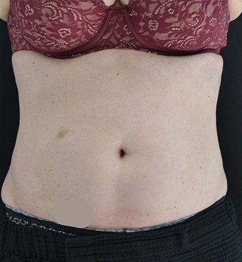 After Image: Abdomen - front