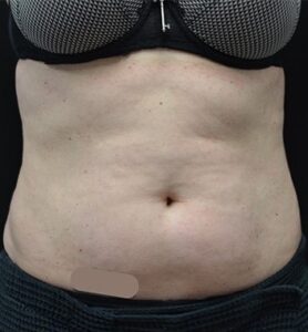 Before Image: Abdomen