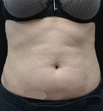 Before Image: Abdomen - front