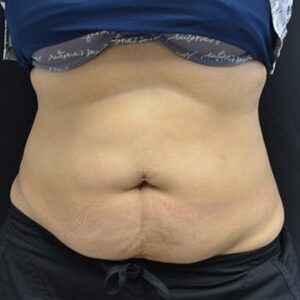 After Image: Abdomen