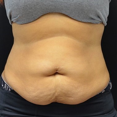 Before Image: Abdomen - front
