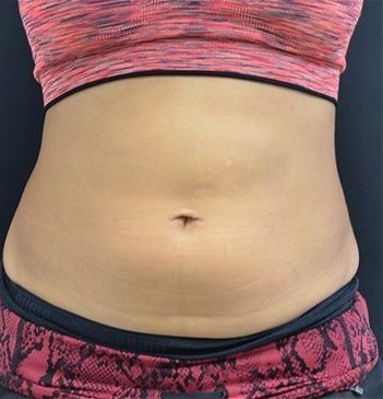 After Image: Abdomen - front