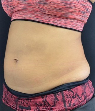 After Image: Abdomen - left-front-oblique