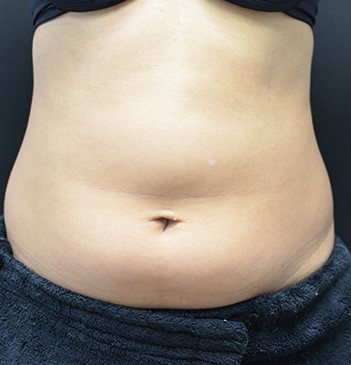 Before Image: Abdomen - front