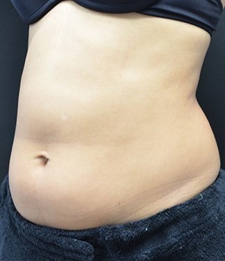 Before Image: Abdomen - left-front-oblique