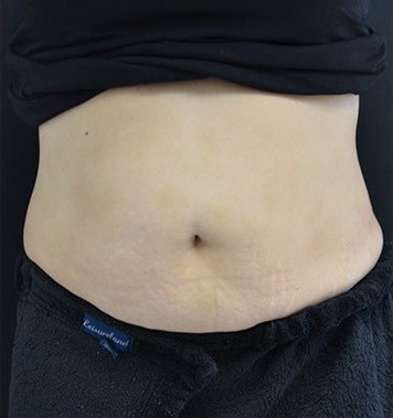 After Image: Abdomen - front