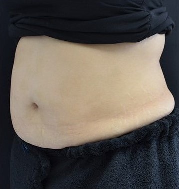 After Image: Abdomen - left-front-oblique