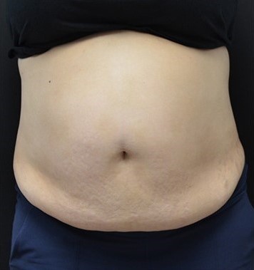 Before Image: Abdomen - front