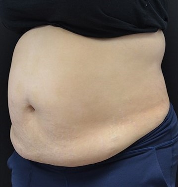 Before Image: Abdomen - left-front-oblique