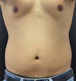After Image: Abdomen - front