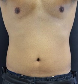 After Image: Abdomen - front