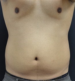 Before Image: Abdomen - front