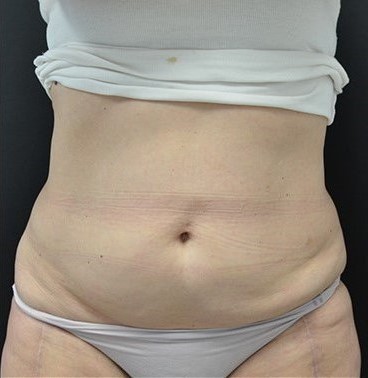 After Image: Abdomen - front