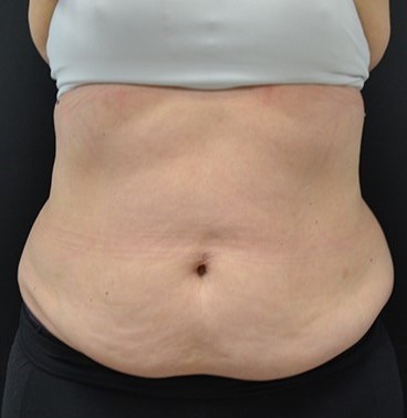 Before Image: Abdomen - front