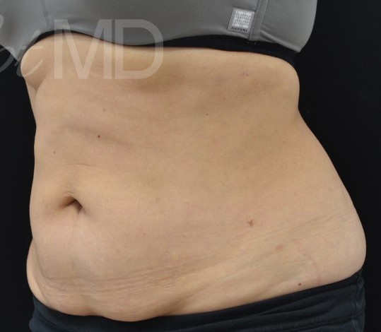 After Image: Abdomen - left-front-oblique