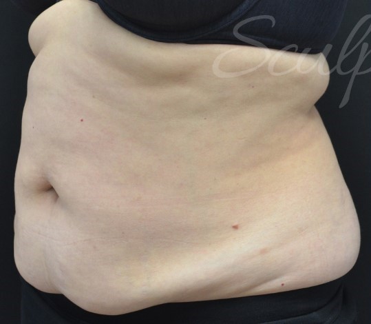 Before Image: Abdomen - left-front-oblique