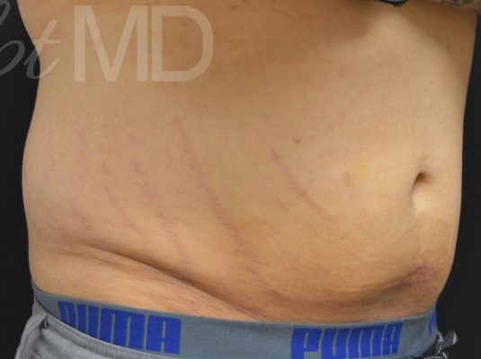 After Image: Abdomen - right-front-oblique