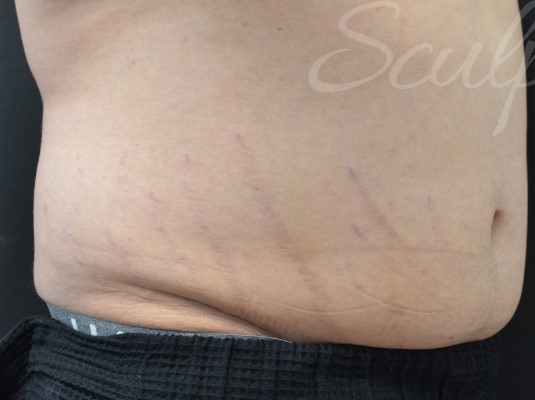Before Image: Abdomen - right-front-oblique