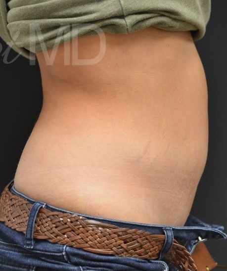 After Image: Abdomen - right-side