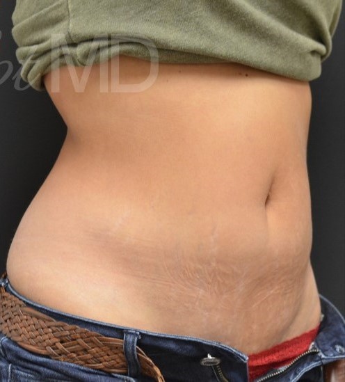 After Image: Abdomen - right-front-oblique