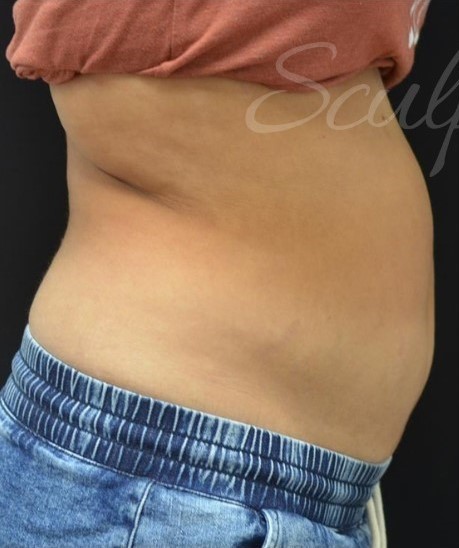 Before Image: Abdomen - right-side