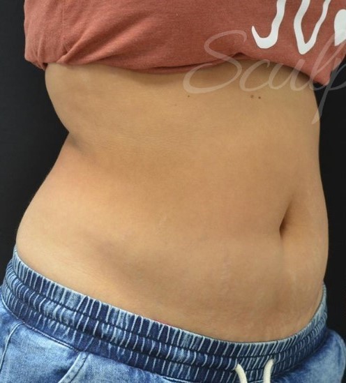 Before Image: Abdomen - right-front-oblique