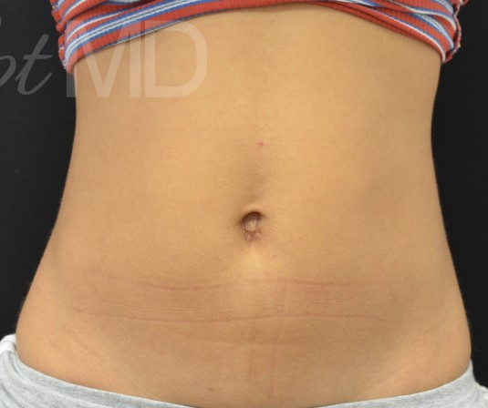 After Image: Abdomen - front
