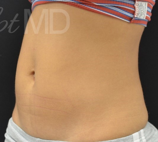 After Image: Abdomen - left-front-oblique
