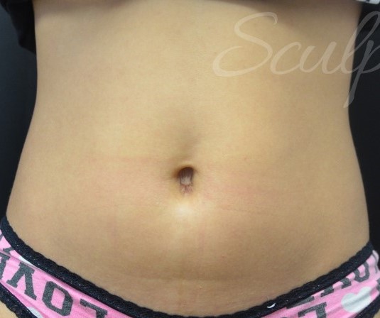 Before Image: Abdomen - front