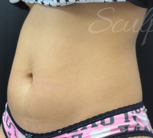Before Image: Abdomen - left-front-oblique
