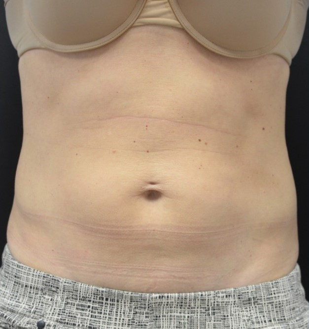 After Image: Abdomen - front
